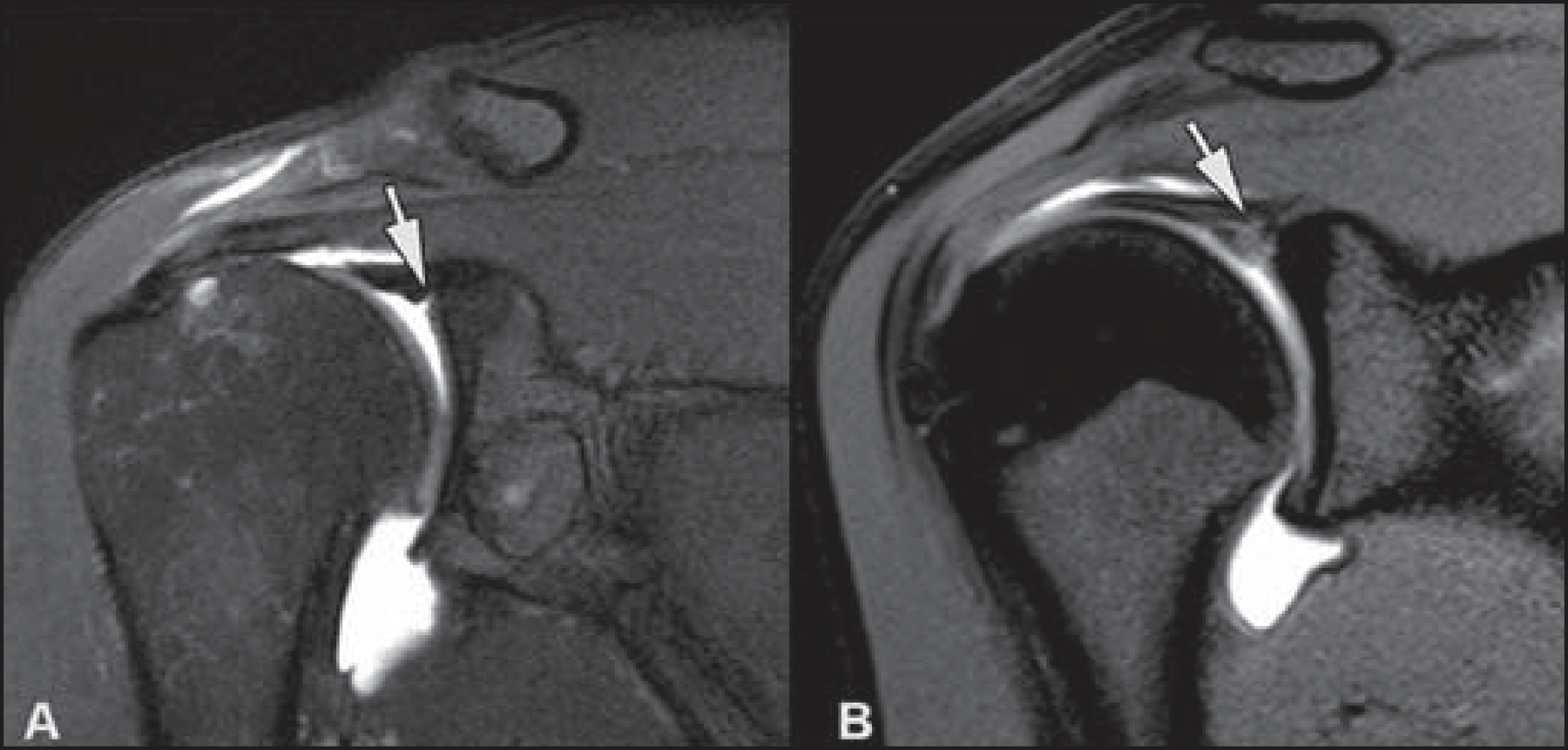 Shoulder Labral Tear